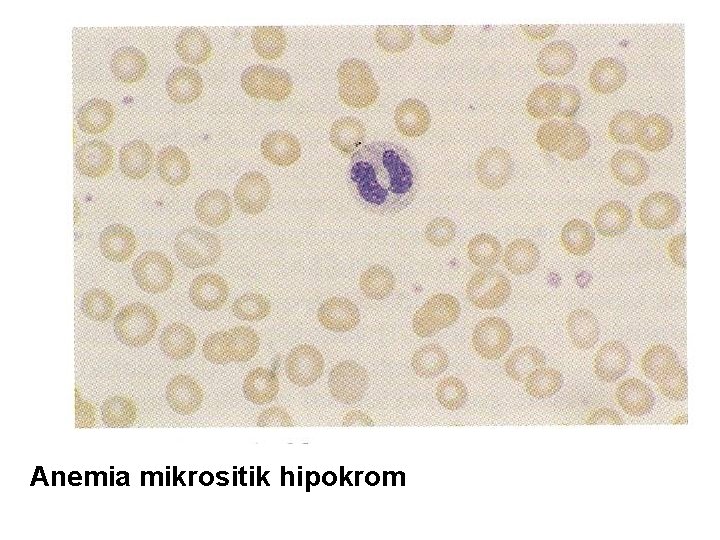 Anemia mikrositik hipokrom 