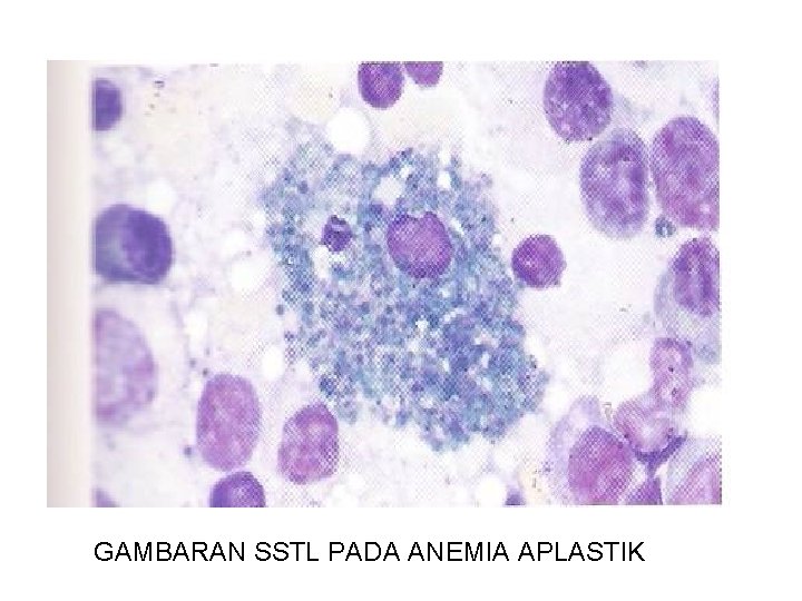 GAMBARAN SSTL PADA ANEMIA APLASTIK 