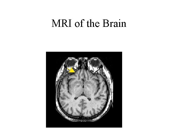 MRI of the Brain 