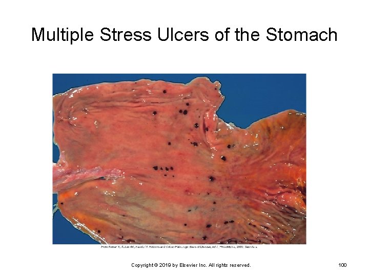 Multiple Stress Ulcers of the Stomach Copyright © 2019 by Elsevier Inc. All rights