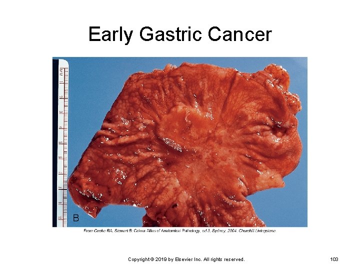 Early Gastric Cancer Copyright © 2019 by Elsevier Inc. All rights reserved. 103 