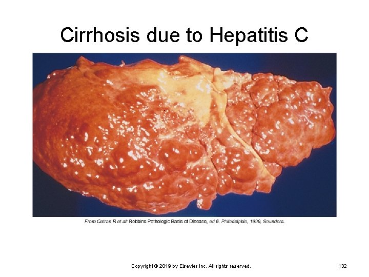 Cirrhosis due to Hepatitis C Copyright © 2019 by Elsevier Inc. All rights reserved.