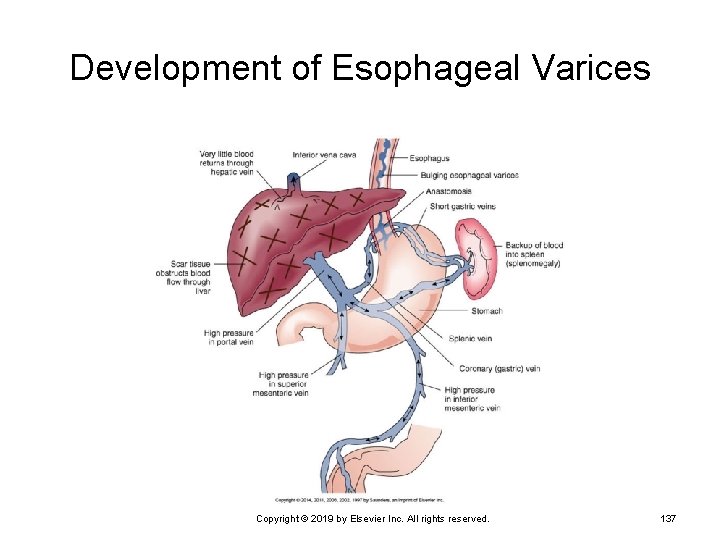 Development of Esophageal Varices Copyright © 2019 by Elsevier Inc. All rights reserved. 137