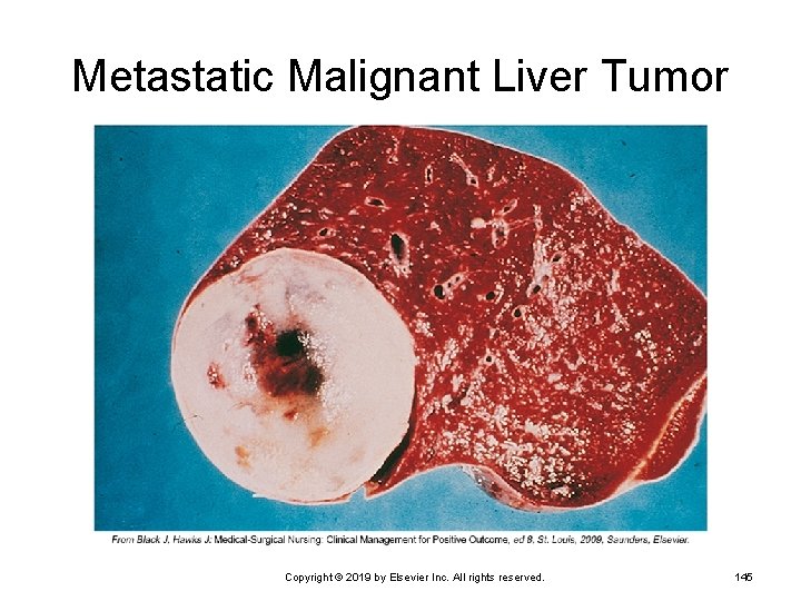 Metastatic Malignant Liver Tumor Copyright © 2019 by Elsevier Inc. All rights reserved. 145