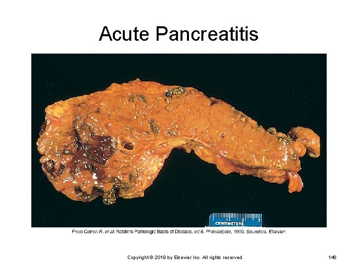Acute Pancreatitis Copyright © 2019 by Elsevier Inc. All rights reserved. 148 