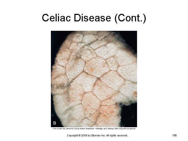 Celiac Disease (Cont. ) Copyright © 2019 by Elsevier Inc. All rights reserved. 155