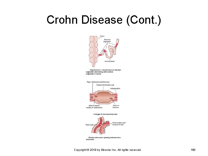 Crohn Disease (Cont. ) Copyright © 2019 by Elsevier Inc. All rights reserved. 160