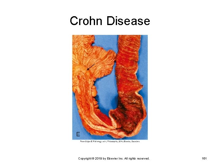 Crohn Disease Copyright © 2019 by Elsevier Inc. All rights reserved. 161 