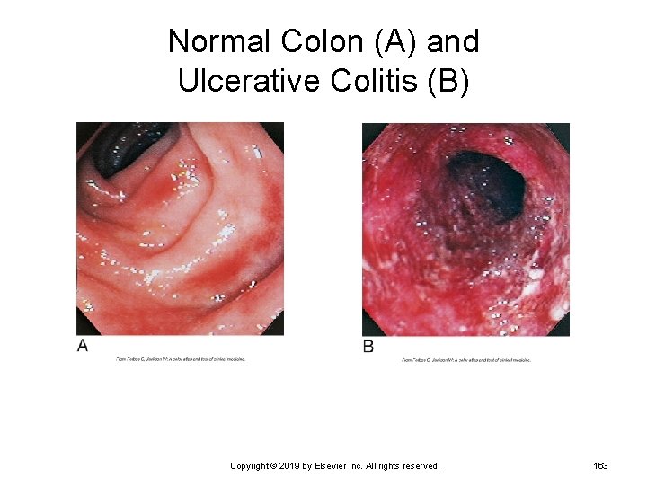 Normal Colon (A) and Ulcerative Colitis (B) Copyright © 2019 by Elsevier Inc. All
