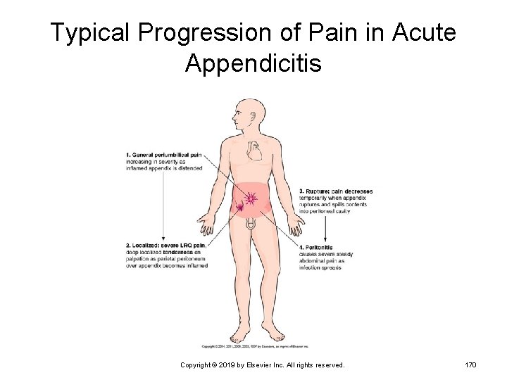 Typical Progression of Pain in Acute Appendicitis Copyright © 2019 by Elsevier Inc. All