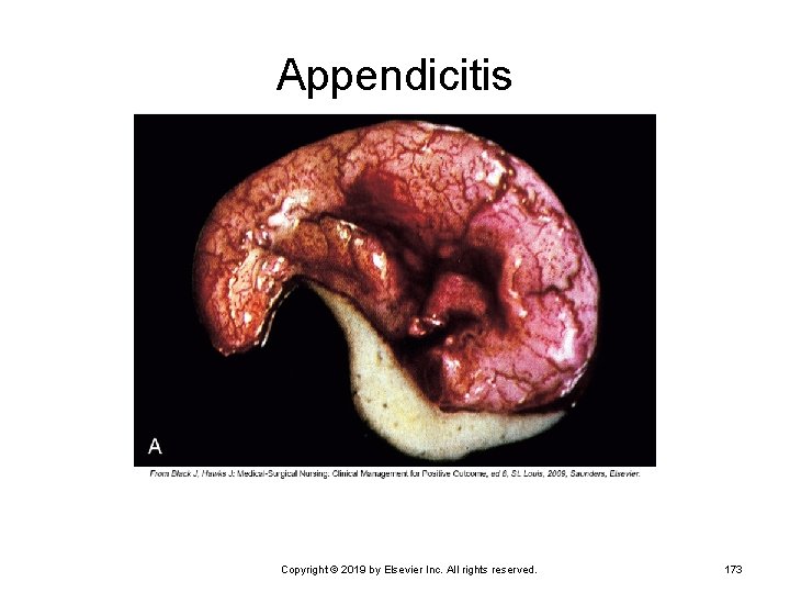 Appendicitis Copyright © 2019 by Elsevier Inc. All rights reserved. 173 