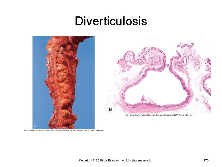 Diverticulosis Copyright © 2019 by Elsevier Inc. All rights reserved. 176 