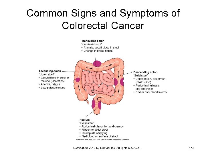 Common Signs and Symptoms of Colorectal Cancer Copyright © 2019 by Elsevier Inc. All