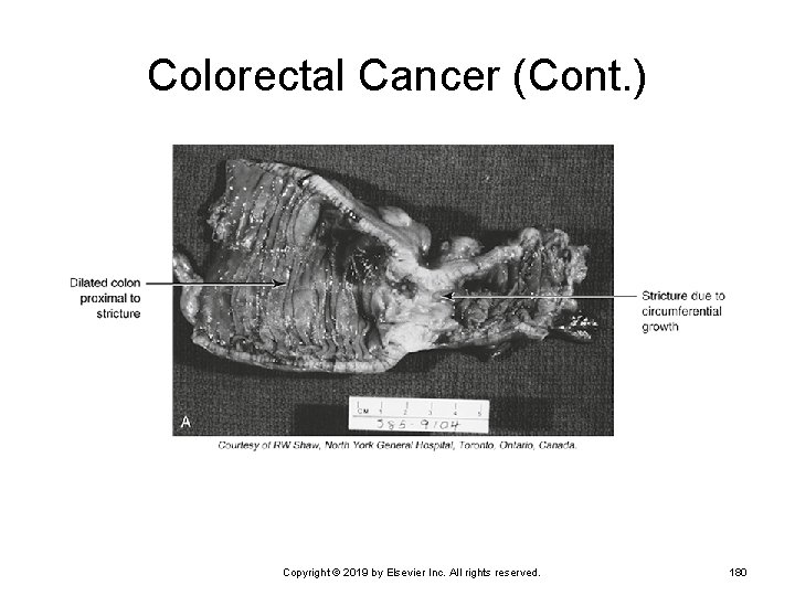 Colorectal Cancer (Cont. ) Copyright © 2019 by Elsevier Inc. All rights reserved. 180