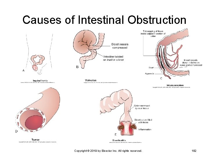 Causes of Intestinal Obstruction Copyright © 2019 by Elsevier Inc. All rights reserved. 182