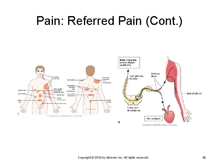 Pain: Referred Pain (Cont. ) Copyright © 2019 by Elsevier Inc. All rights reserved.