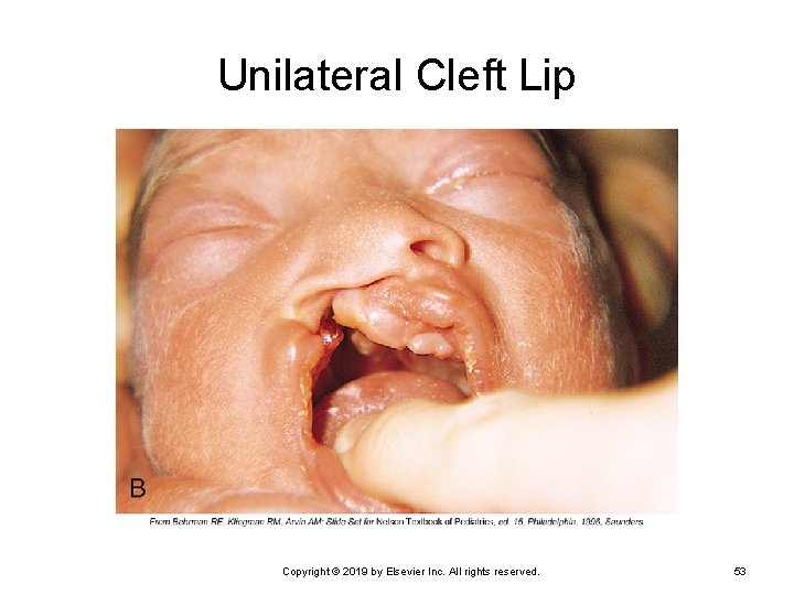 Unilateral Cleft Lip Copyright © 2019 by Elsevier Inc. All rights reserved. 53 