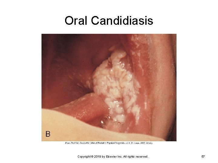 Oral Candidiasis Copyright © 2019 by Elsevier Inc. All rights reserved. 57 