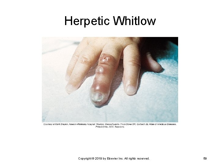 Herpetic Whitlow Copyright © 2019 by Elsevier Inc. All rights reserved. 59 