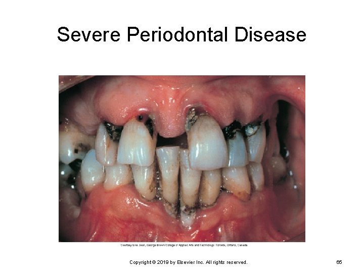 Severe Periodontal Disease Copyright © 2019 by Elsevier Inc. All rights reserved. 65 