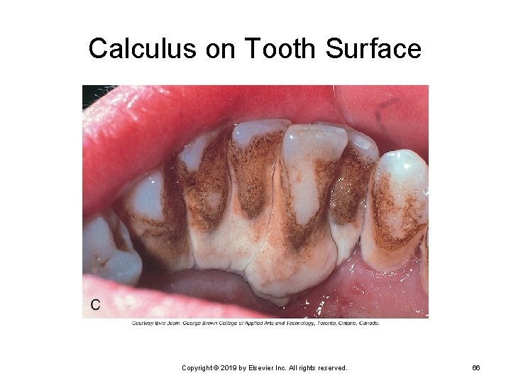 Calculus on Tooth Surface Copyright © 2019 by Elsevier Inc. All rights reserved. 66