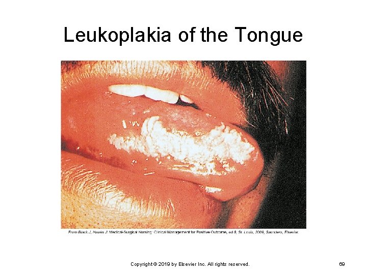 Leukoplakia of the Tongue Copyright © 2019 by Elsevier Inc. All rights reserved. 69