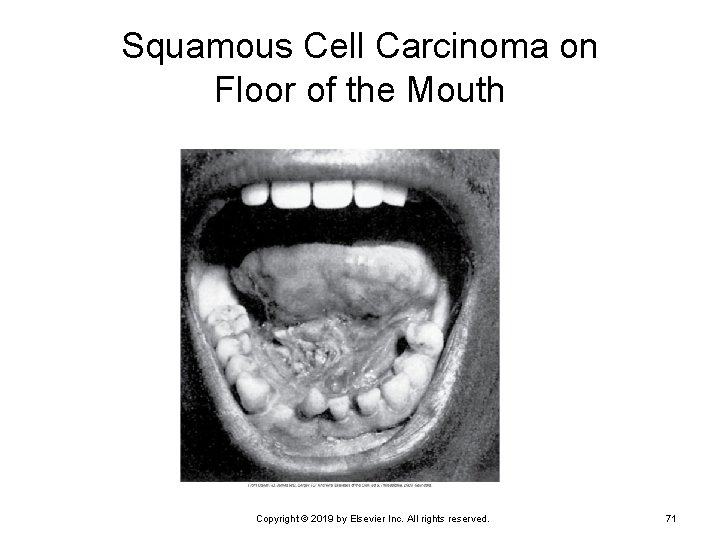 Squamous Cell Carcinoma on Floor of the Mouth Copyright © 2019 by Elsevier Inc.