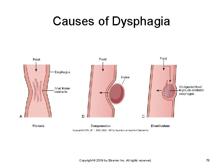Causes of Dysphagia Copyright © 2019 by Elsevier Inc. All rights reserved. 78 