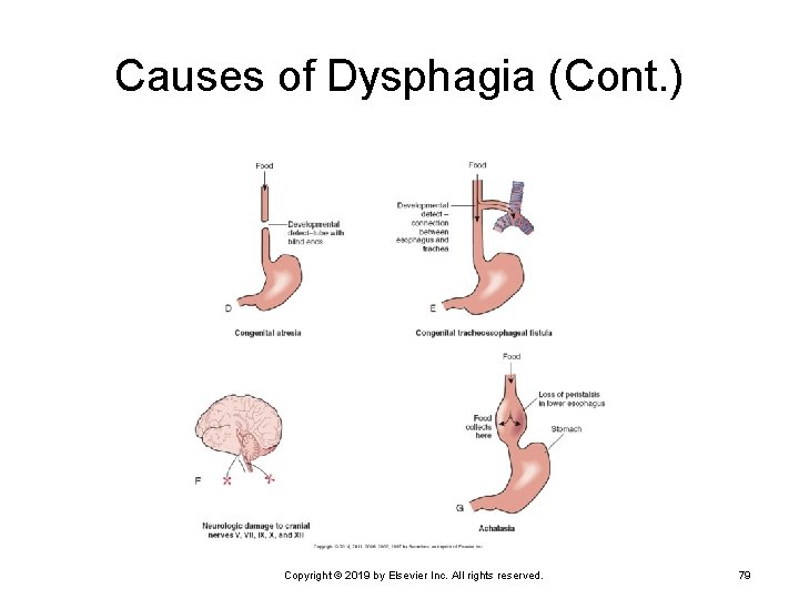 Causes of Dysphagia (Cont. ) Copyright © 2019 by Elsevier Inc. All rights reserved.