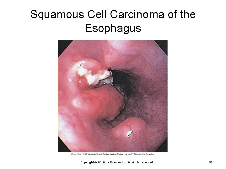 Squamous Cell Carcinoma of the Esophagus Copyright © 2019 by Elsevier Inc. All rights
