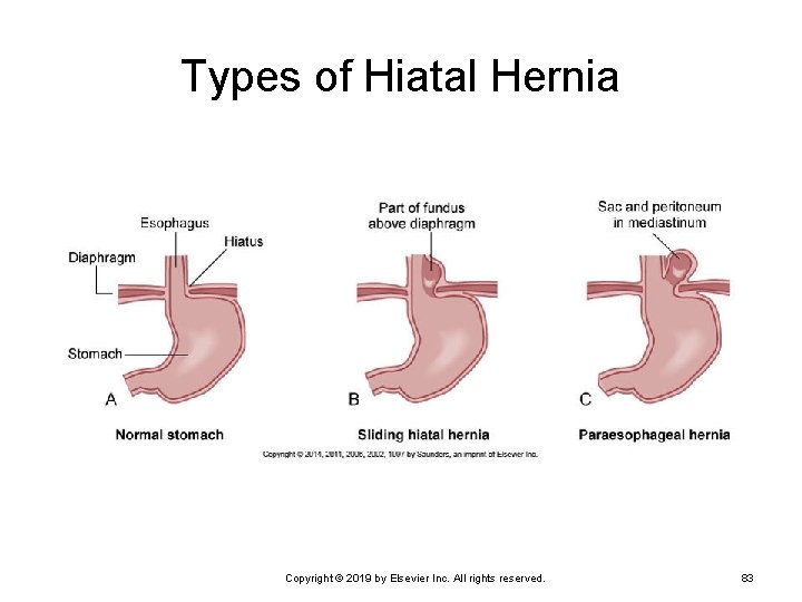 Types of Hiatal Hernia Copyright © 2019 by Elsevier Inc. All rights reserved. 83