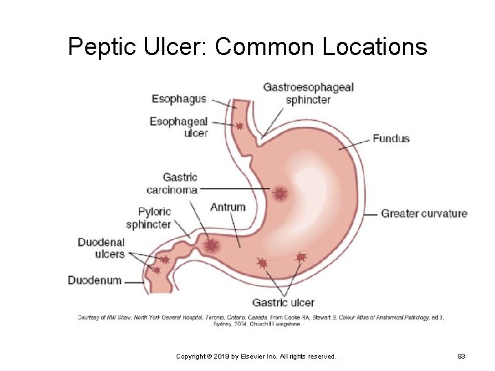 Peptic Ulcer: Common Locations Copyright © 2019 by Elsevier Inc. All rights reserved. 93