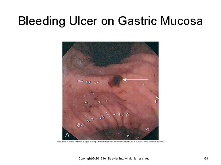 Bleeding Ulcer on Gastric Mucosa Copyright © 2019 by Elsevier Inc. All rights reserved.