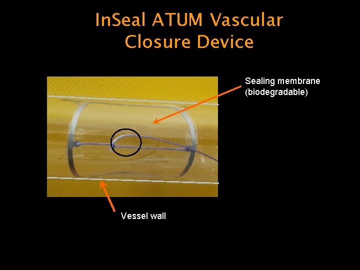 In. Seal ATUM Vascular Closure Device Sealing membrane (biodegradable) Vessel wall 