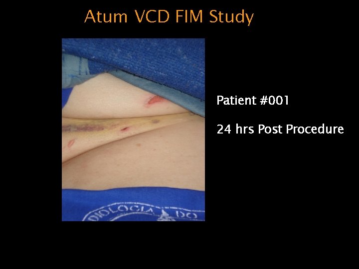 Atum VCD FIM Study Patient #001 24 hrs Post Procedure 