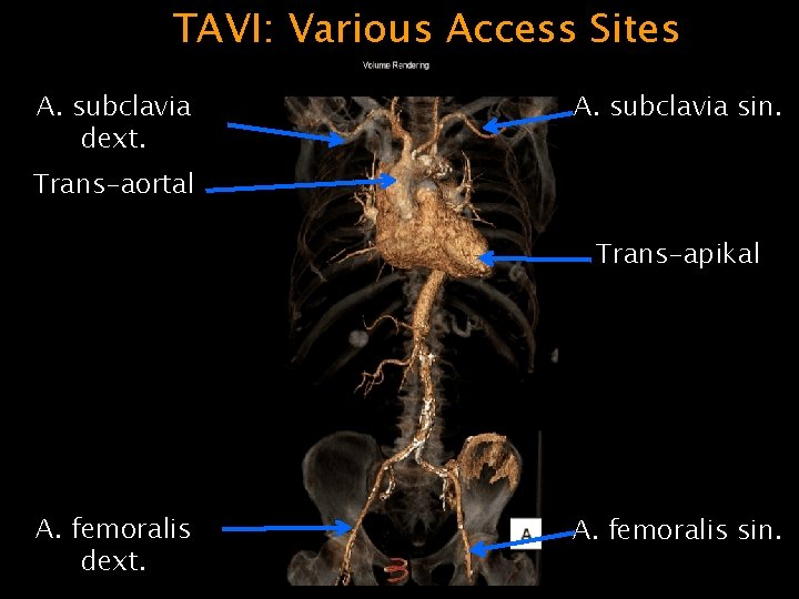 TAVI: Various Access Sites A. subclavia dext. A. subclavia sin. Trans-aortal Trans-apikal A. femoralis
