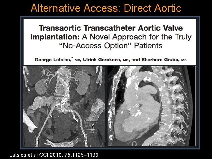 Alternative Access: Direct Aortic Latsios et al CCI 2010; 75: 1129– 1136 