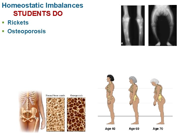 Homeostatic Imbalances STUDENTS DO § Rickets § Osteoporosis 