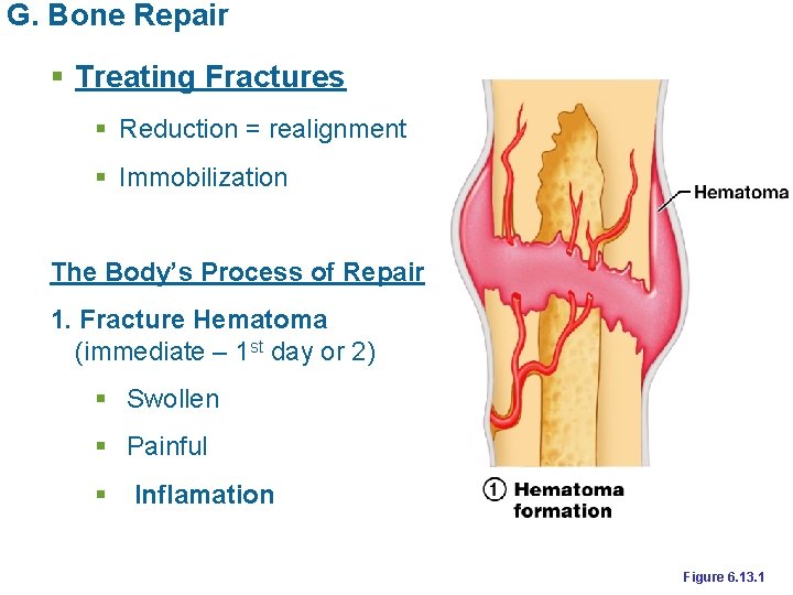 G. Bone Repair § Treating Fractures § Reduction = realignment § Immobilization The Body’s