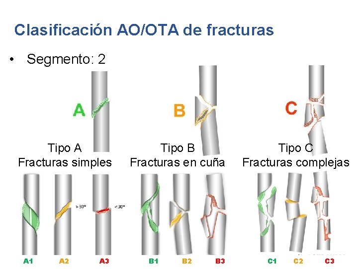 Clasificación AO/OTA de fracturas • Segmento: 2 Tipo A Fracturas simples A 1 A
