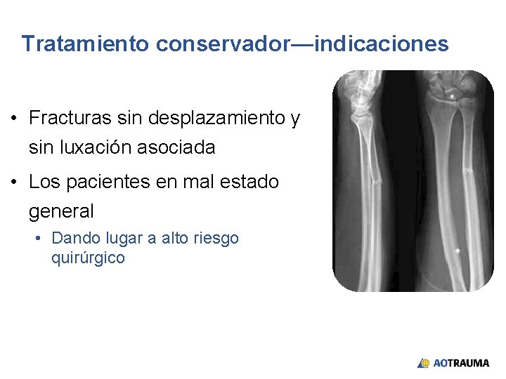 Tratamiento conservador—indicaciones • Fracturas sin desplazamiento y sin luxación asociada • Los pacientes en