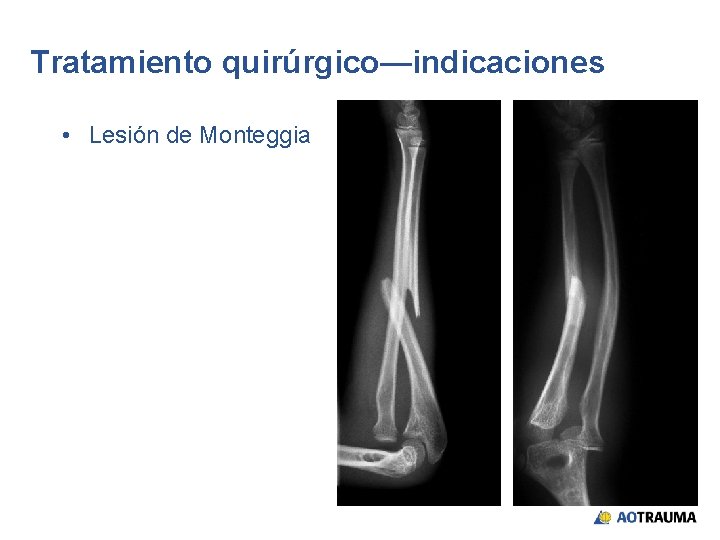 Tratamiento quirúrgico—indicaciones • Lesión de Monteggia 