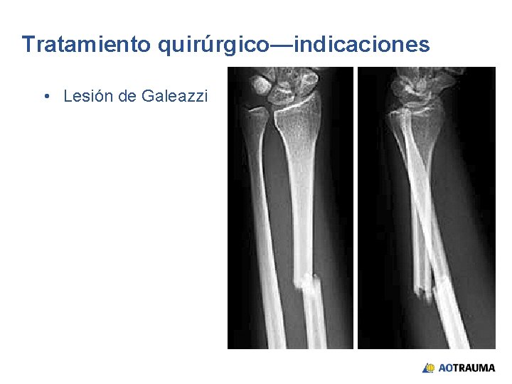 Tratamiento quirúrgico—indicaciones • Lesión de Galeazzi 