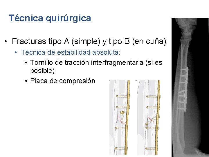 Técnica quirúrgica • Fracturas tipo A (simple) y tipo B (en cuña) • Técnica