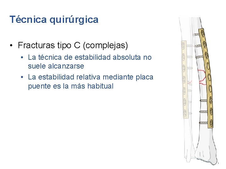 Técnica quirúrgica • Fracturas tipo C (complejas) • La técnica de estabilidad absoluta no