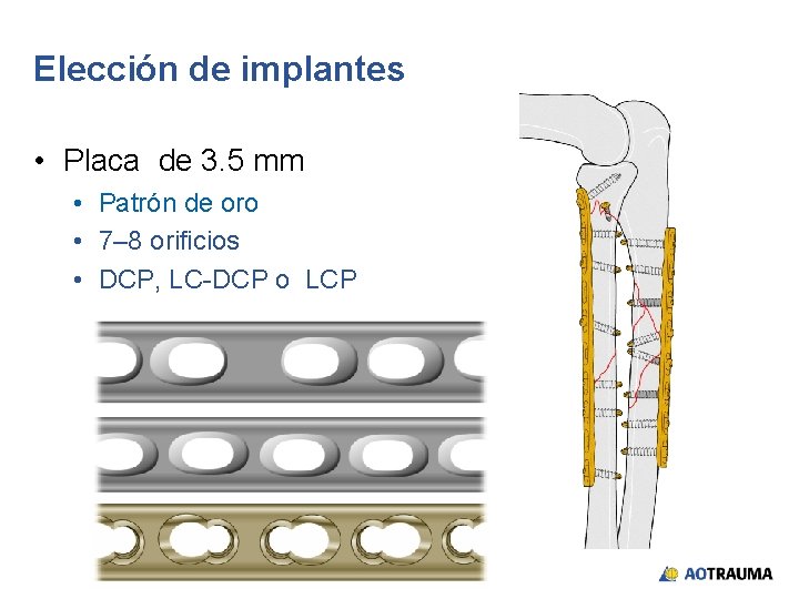 Elección de implantes • Placa de 3. 5 mm • Patrón de oro •