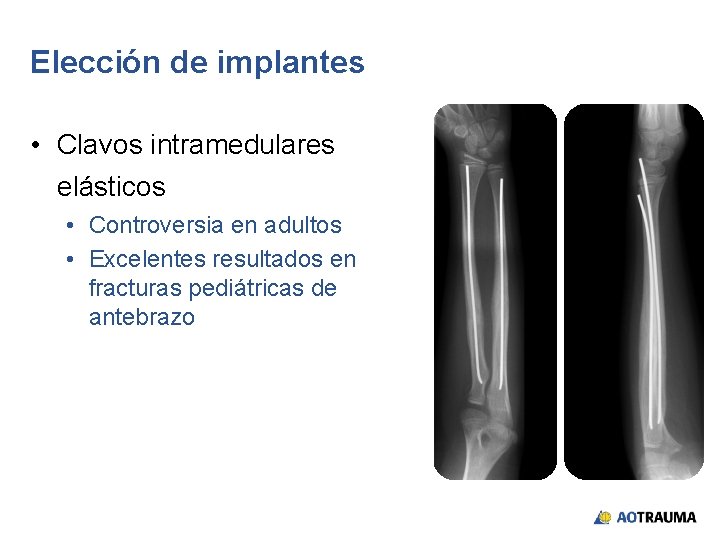 Elección de implantes • Clavos intramedulares elásticos • Controversia en adultos • Excelentes resultados