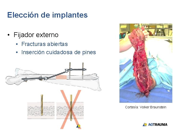 Elección de implantes • Fijador externo • Fracturas abiertas • Inserción cuidadosa de pines