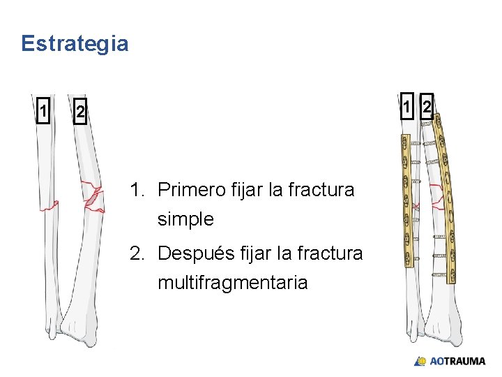 Estrategia 1 1 2 2 1. Primero fijar la fractura simple 2. Después fijar