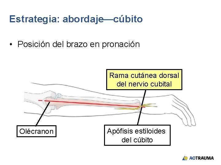 Estrategia: abordaje—cúbito • Posición del brazo en pronación Rama cutánea dorsal del nervio cubital